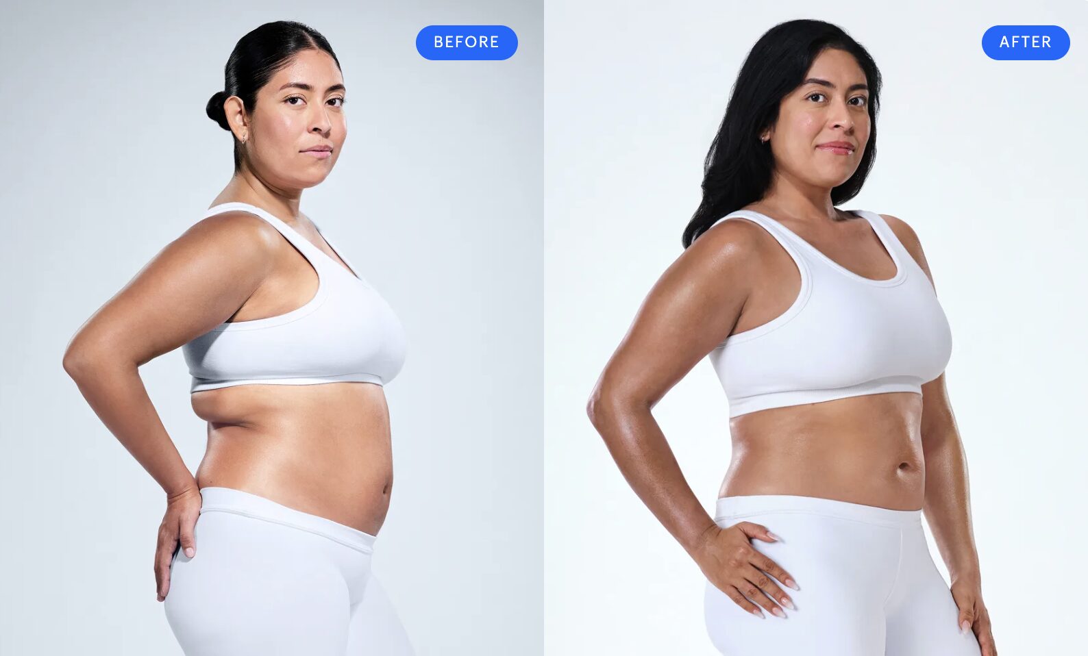 Anali, 35 – CoolSculpting Elite flanks, abdomen and upper arms