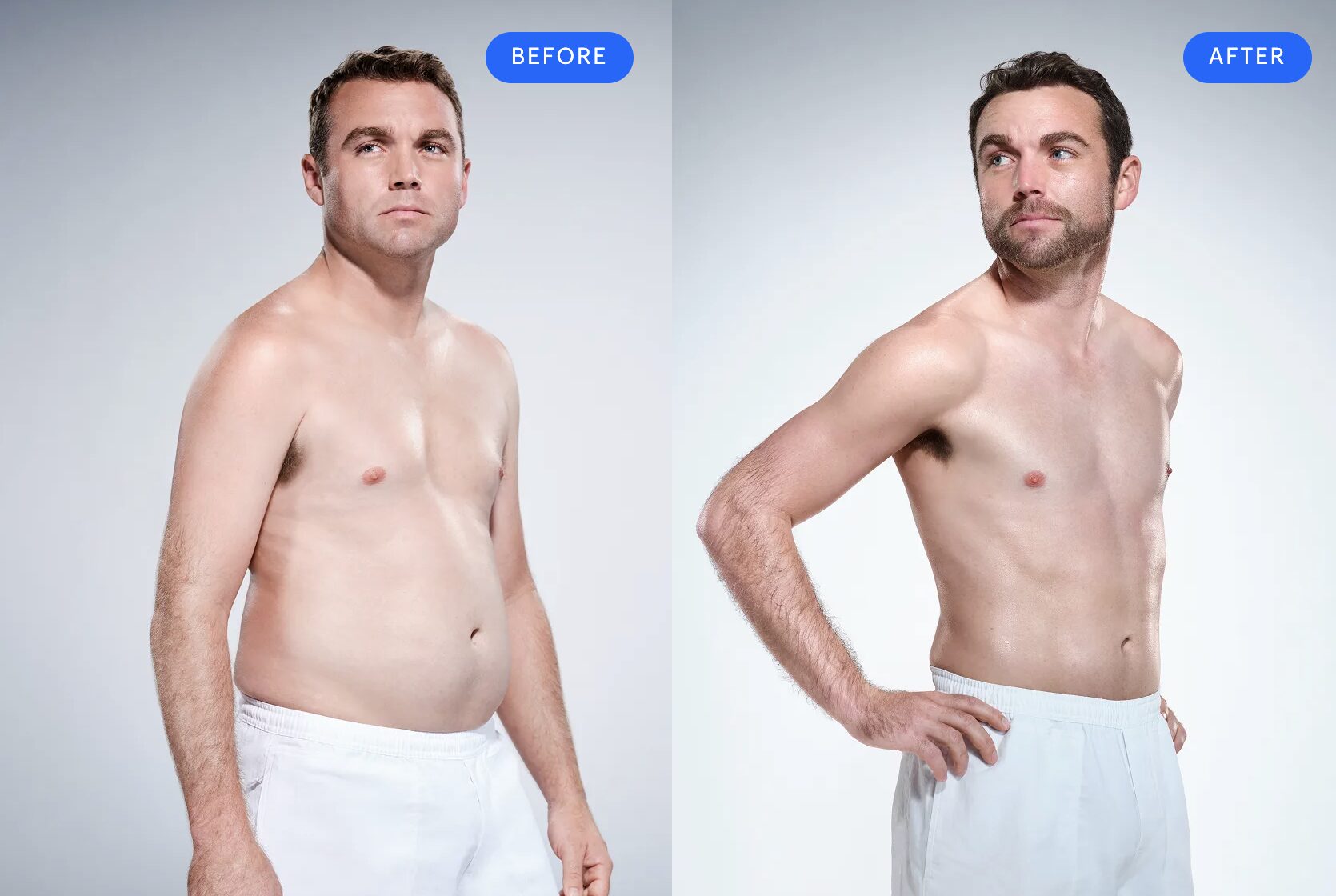 Ryan, 32 – CoolSculpting Elite abdomen, flanks, thighs and double chin