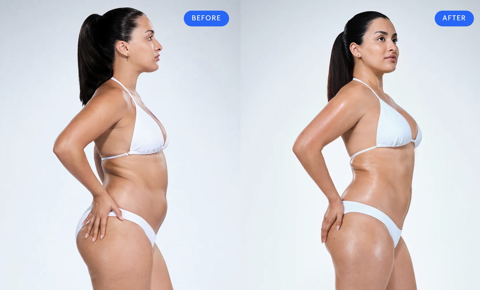 Jazmine, 30 – CoolSculpting Elite arms, thighs, abdomen and flanks