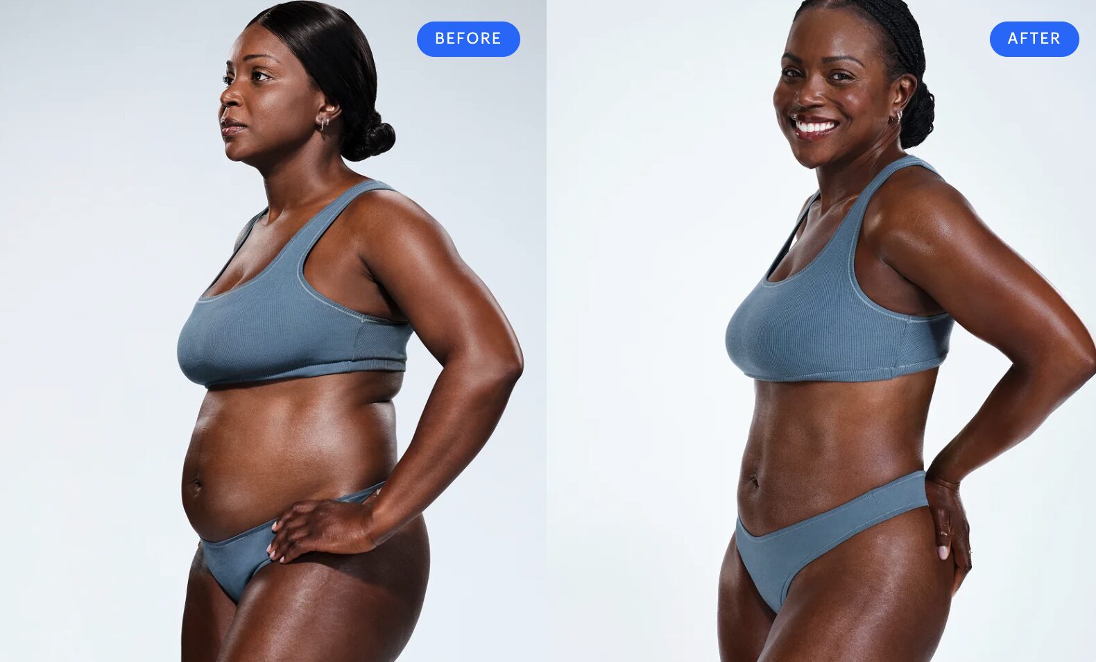 Kenid, 40 – CoolSculpting Elite abdomen, flanks, back fat, bra fat