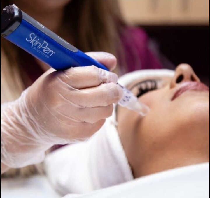 SkinPen microneedling treatment