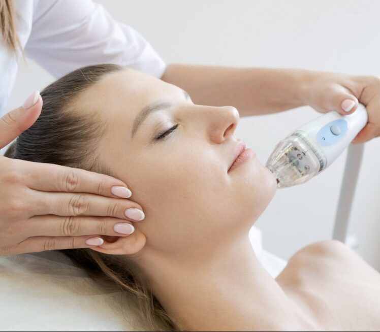 Vivace RF microneedling treatment