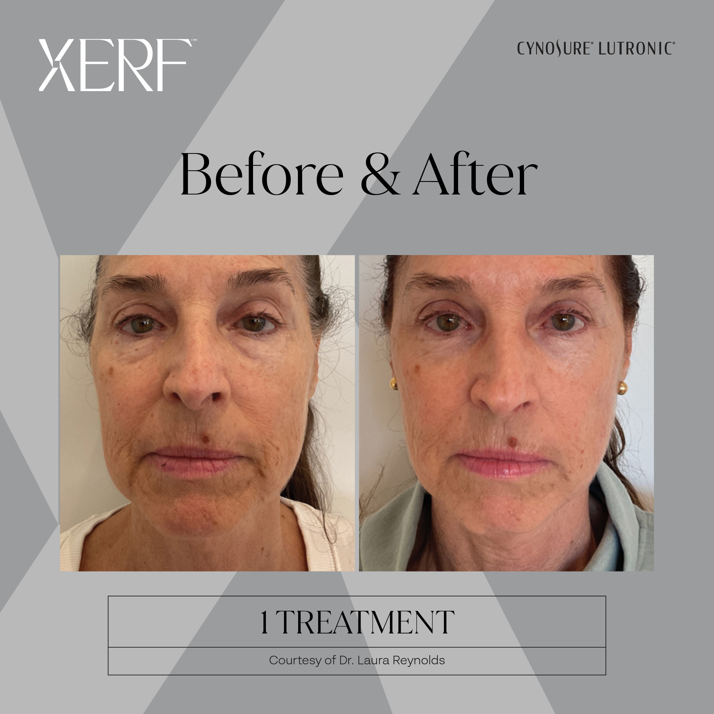 XERF before and after image 6