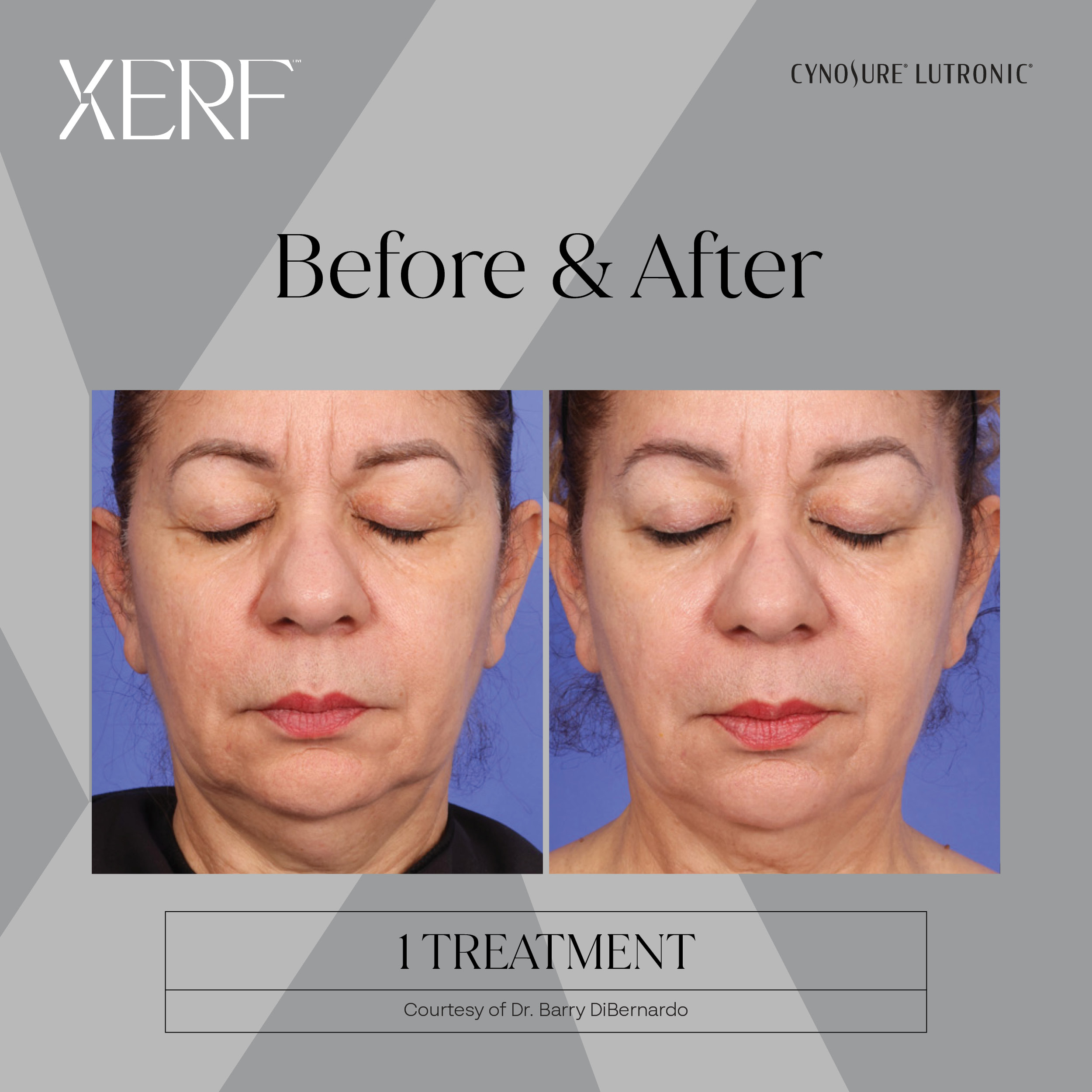XERF before and after image 7