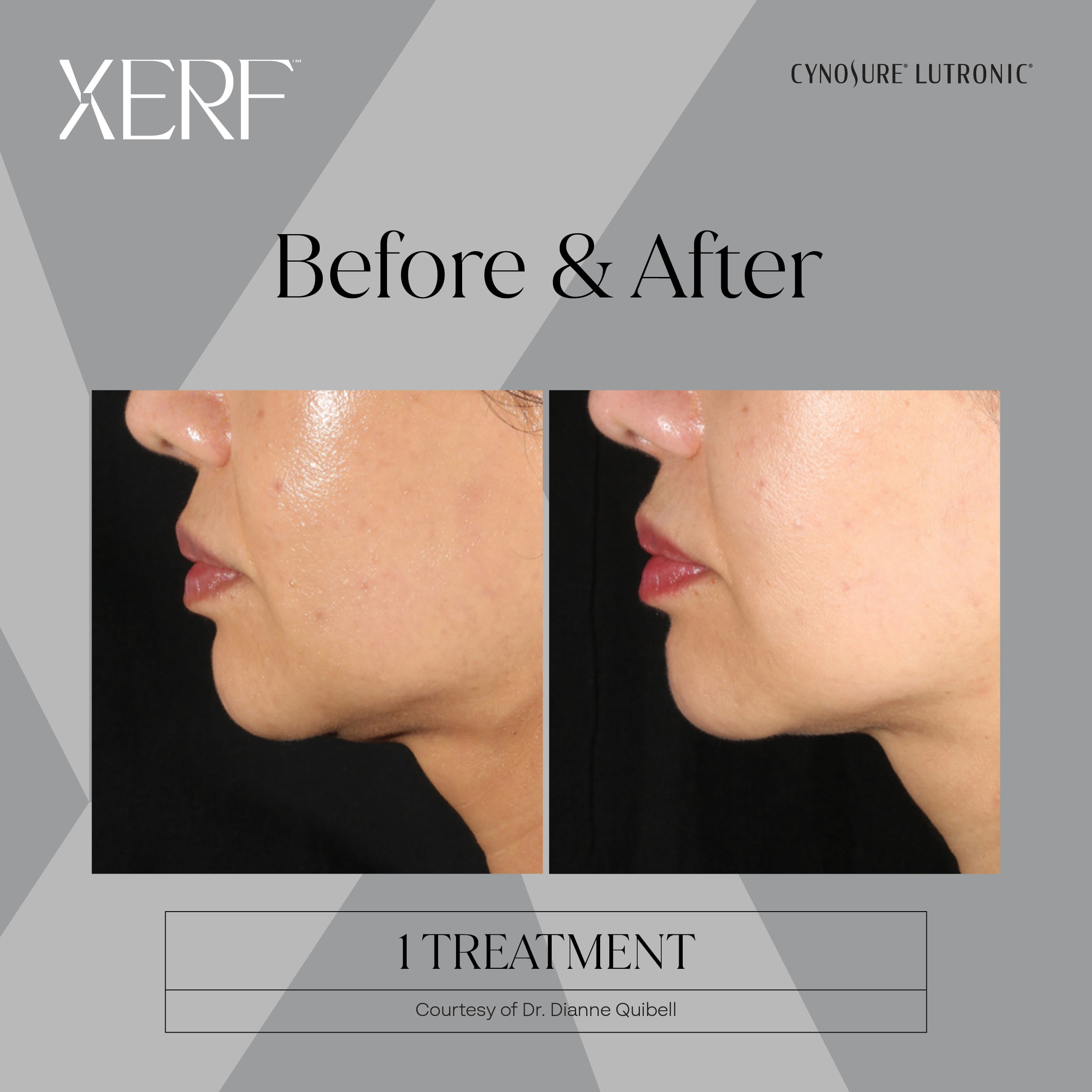 XERF before and after image 2