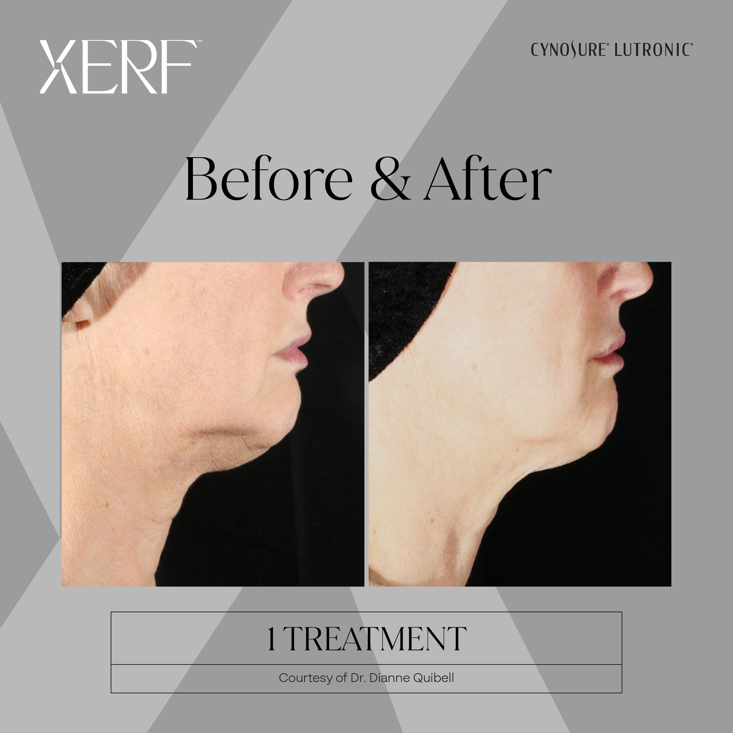 XERF before and after image 3