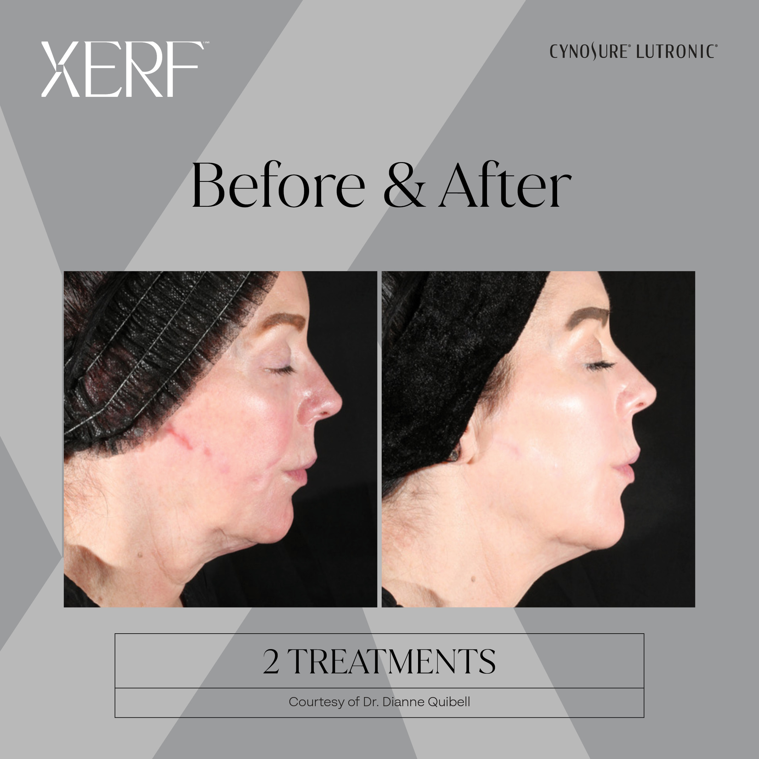 XERF before and after image 4