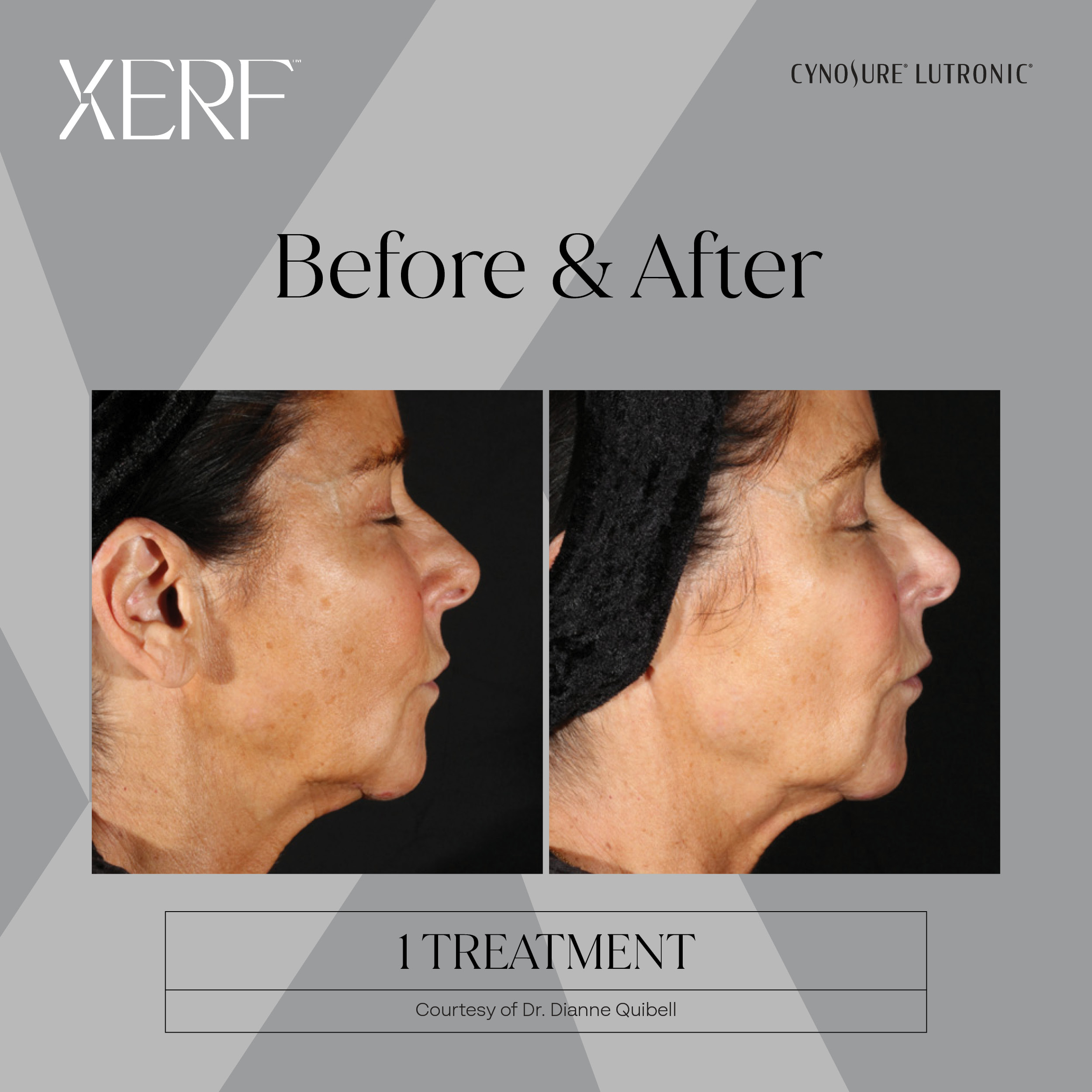 XERF before and after image 5