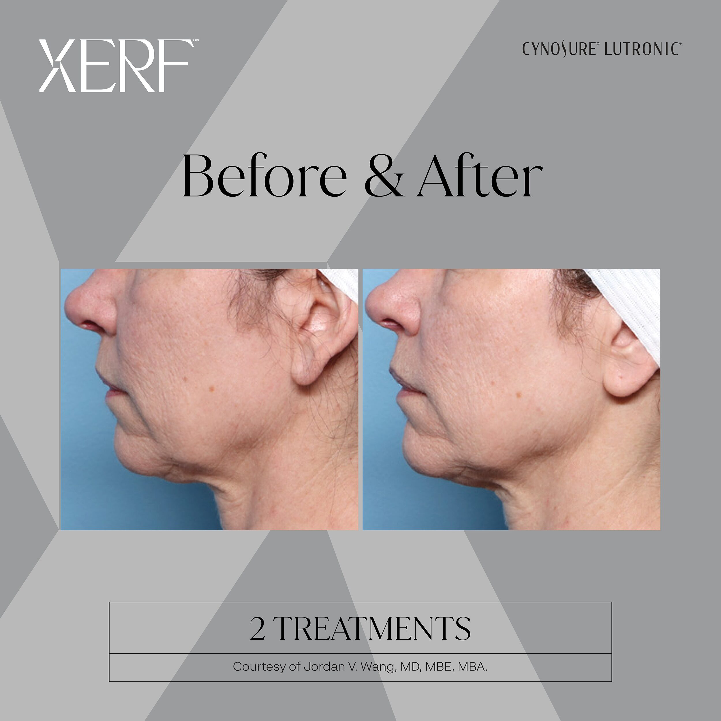 XERF before and after