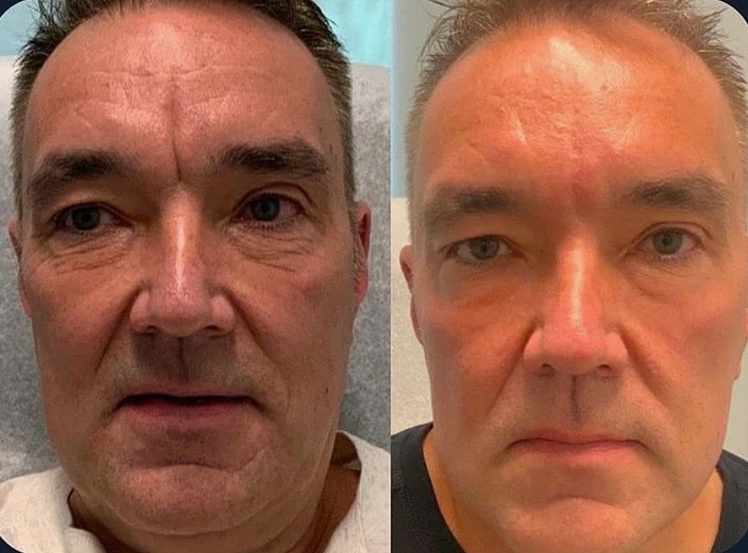 Vivace before and after result showing fine line improvement