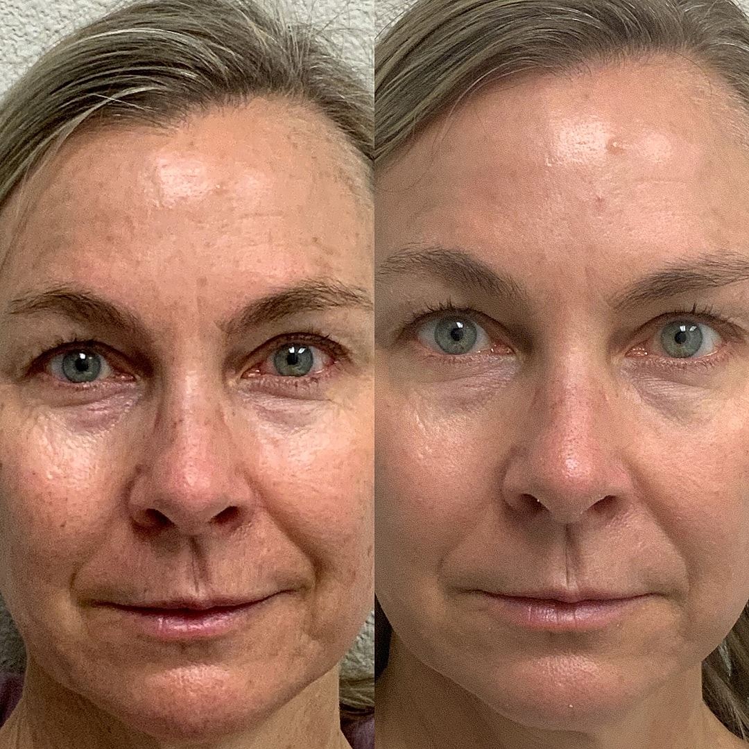 Vivace before and after result showing skin texture improvement