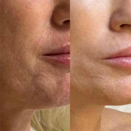 Vivace before and after result showing skin renewal