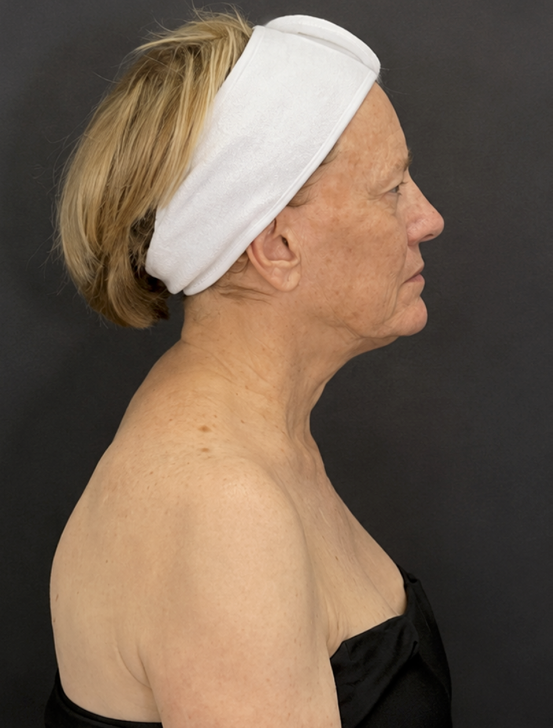 Before XERF treatment, client four