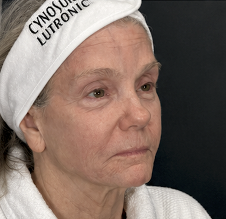 Before XERF treatment, client three