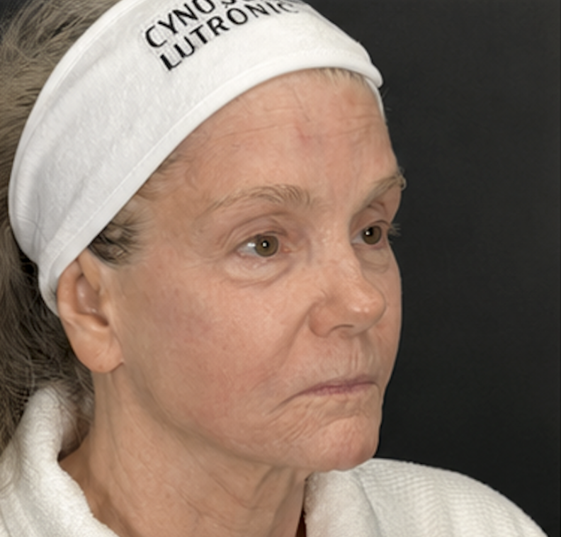 After XERF treatment, client three