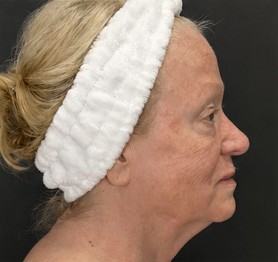 Before XERF treatment, client one