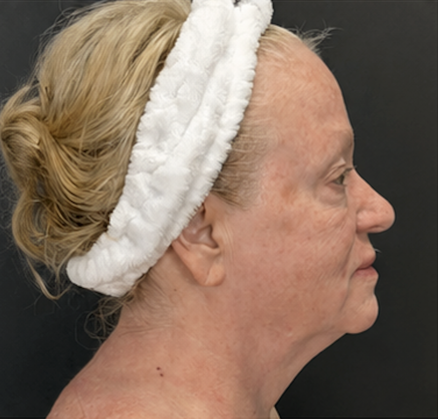 After XERF treatment, client one