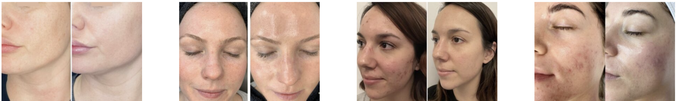 HydraFacial before and after treatment results